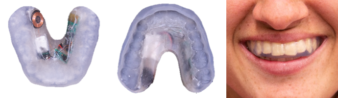 This image shows a smiling mouth and the top and bottom of a light-blue-colored mouthguard.