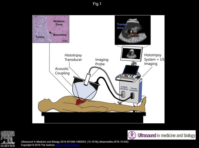 Tamalika_Paul_5 The image shows a conceptual diagram where a focused ultrasound is used to detect and destroy pancreatic cancer tissue in a patient.